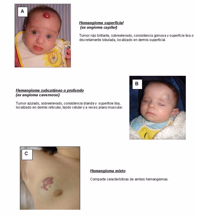 ¿Qué es un hemangioma en la piel?
