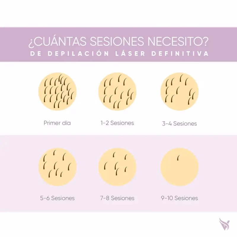 ¿Cuánto tiempo dura el efecto de la depilación láser?