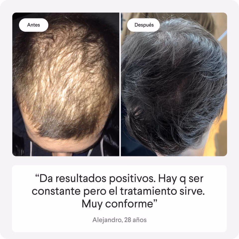 ¿Qué alimentos eliminan el DHT?