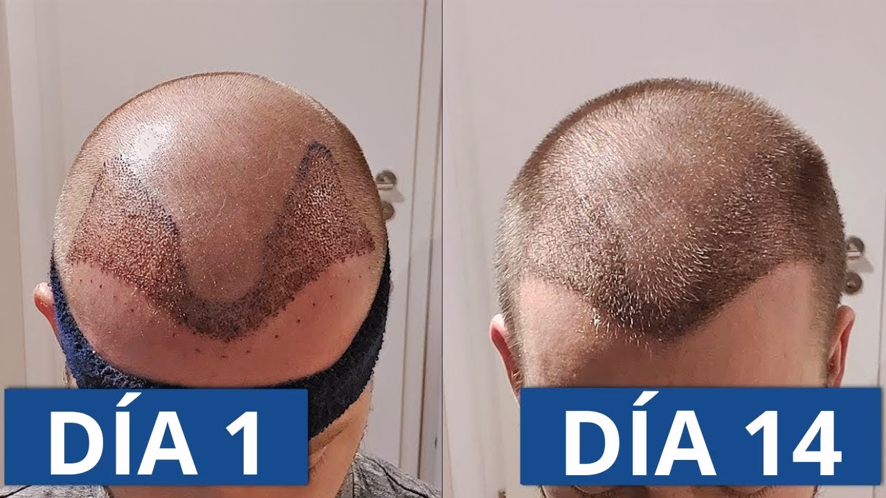 ¿Cuántos días tarda en cicatrizar un injerto capilar?