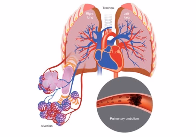 ¿Qué provoca el aumento del flujo sanguíneo a los capilares?