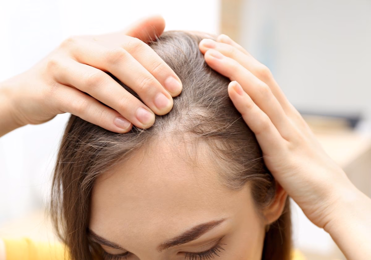 ¿Cómo puedo ocultar la alopecia femenina?