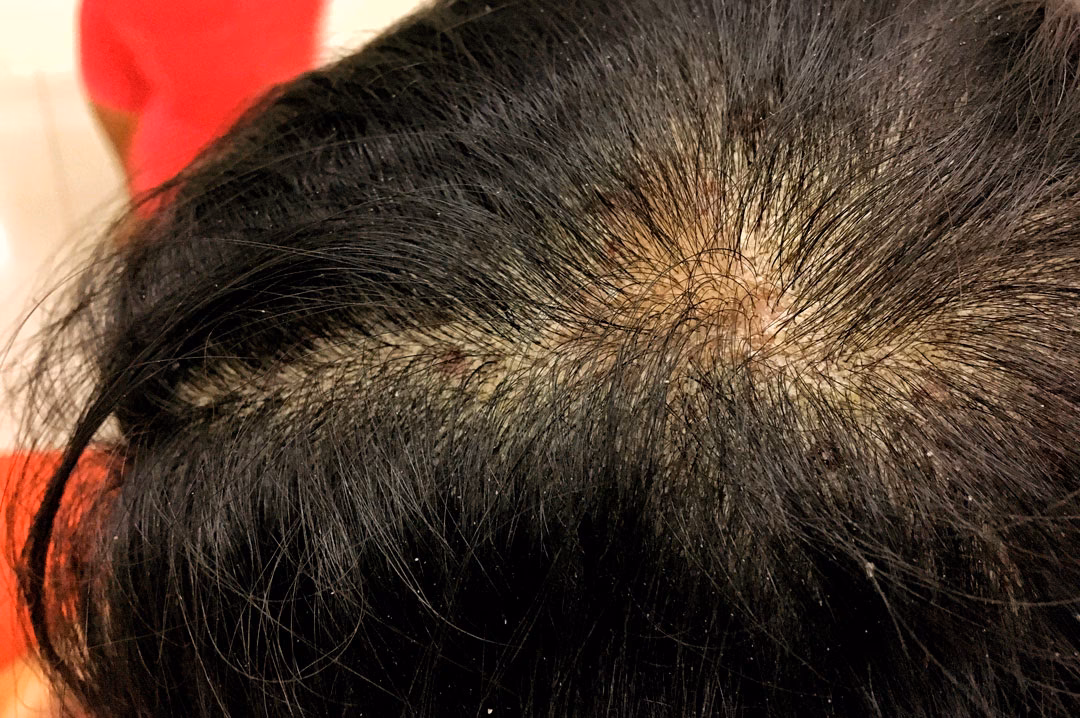 ¿Cuánto dura un eccema en niños?