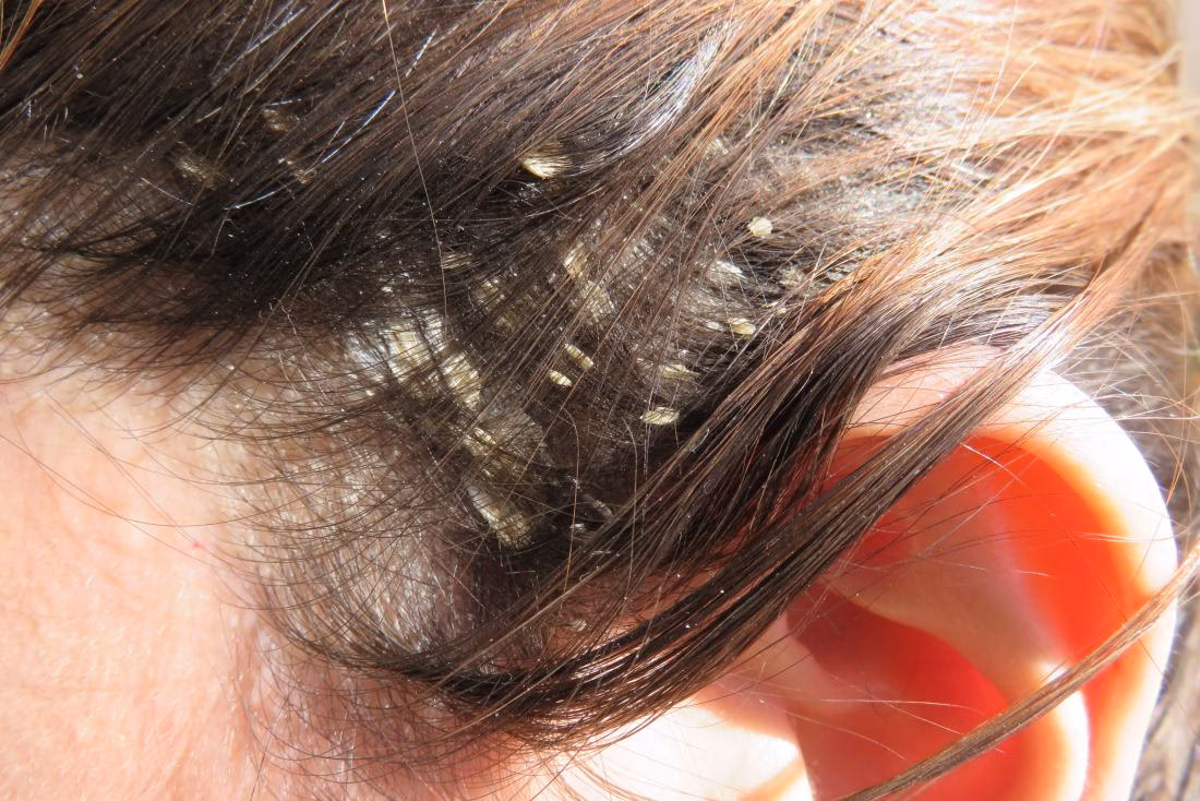 ¿Cuál es el tratamiento para la queratosis seborreica en el cuero cabelludo?