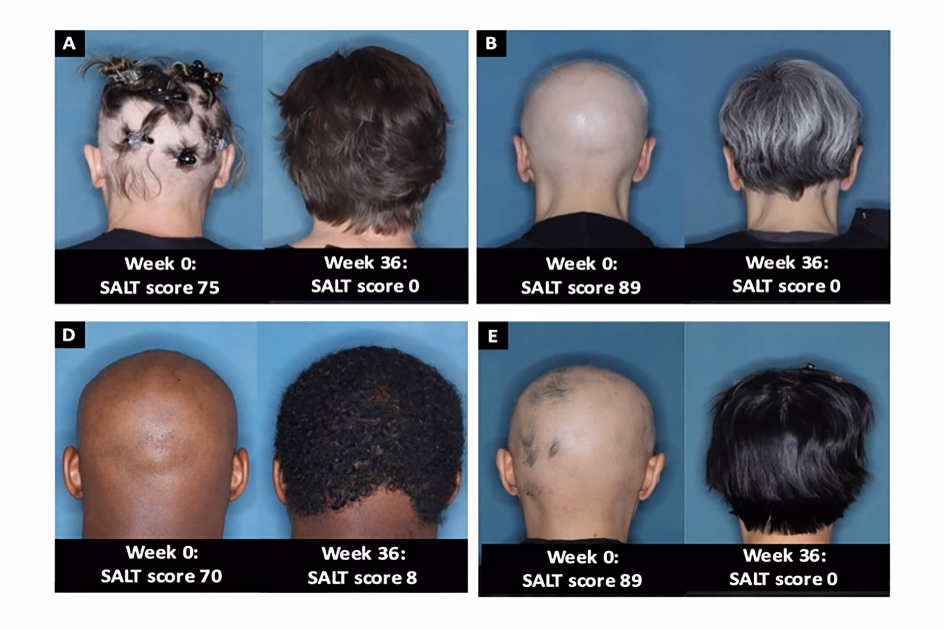 ¿Qué secuelas deja la carbamazepina?