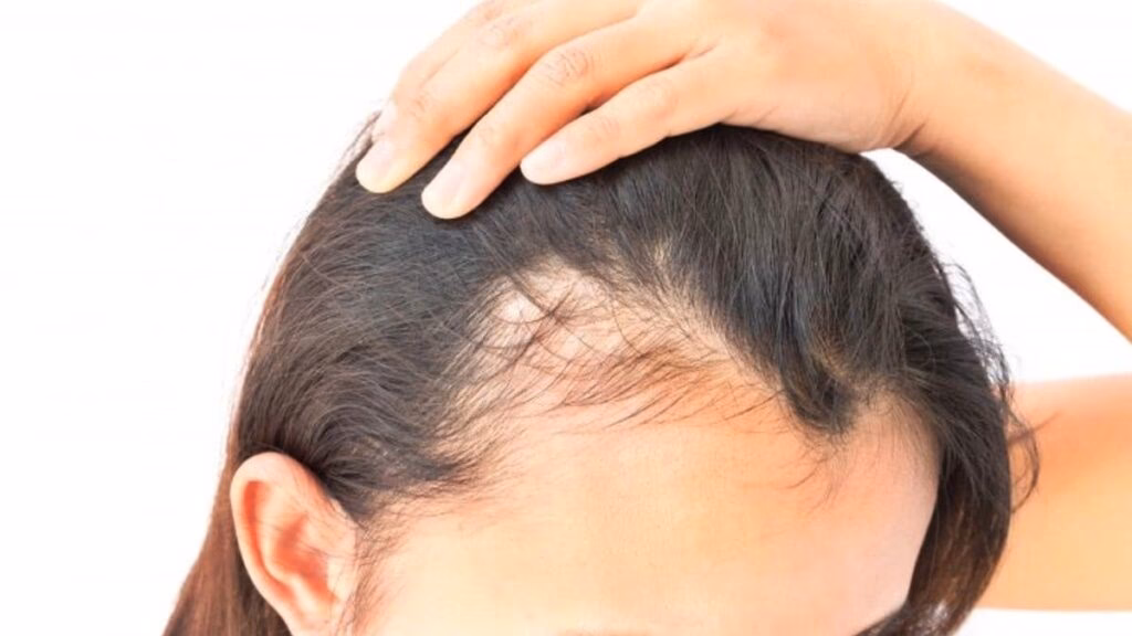 ¿Cómo puedo recuperar el cabello perdido por la dermatitis seborreica?