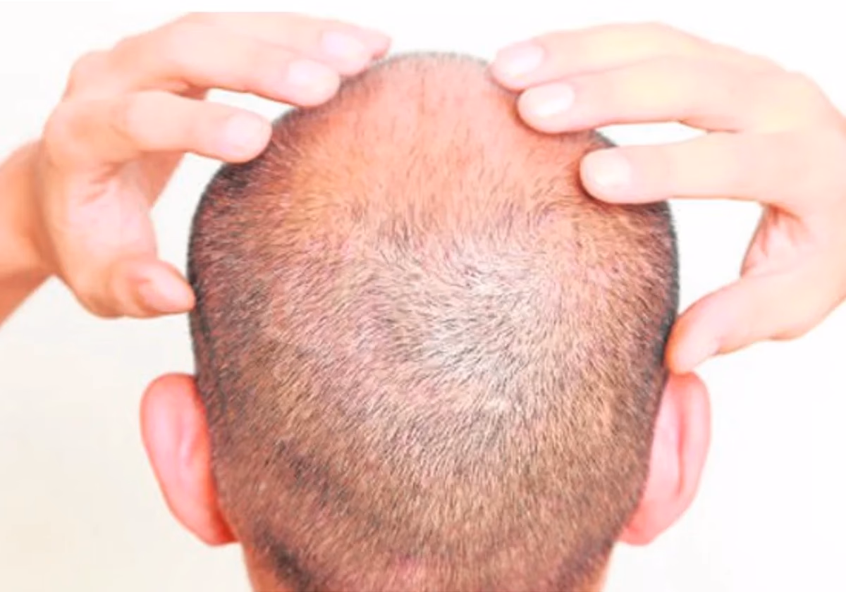 ¿El chocolate hace que se caiga el cabello?