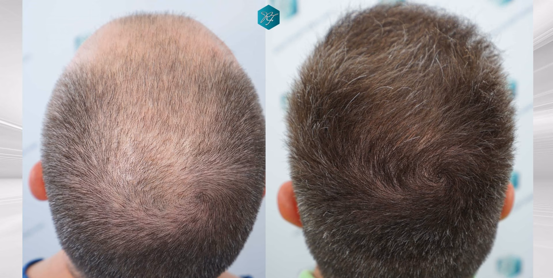 ¿Cómo se inicia la calvicie en la coronilla?