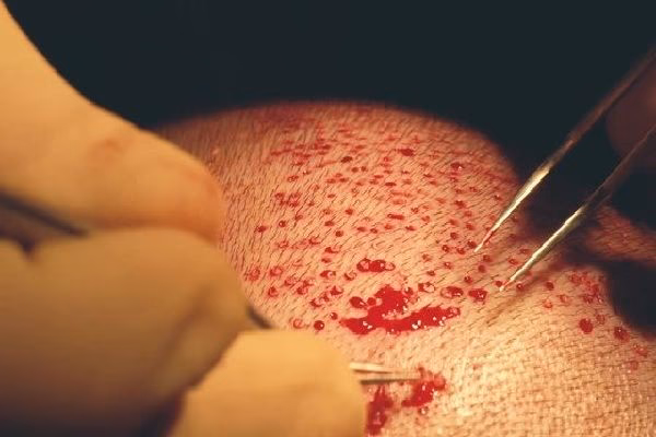 ¿Cuáles son las posibles consecuencias de una cirugía en la cabeza?