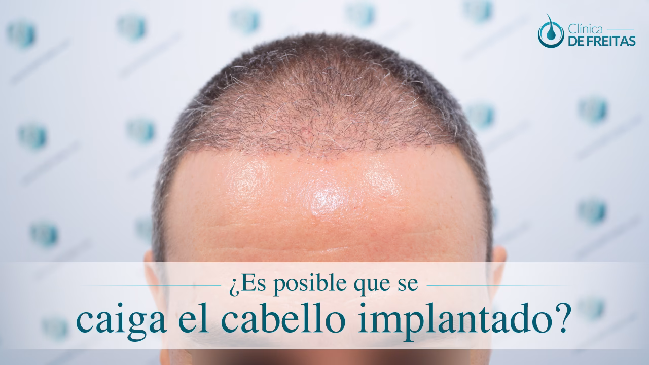 ¿Con el implante se me cae el cabello?