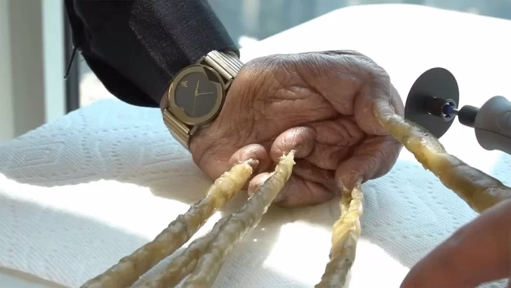 ¿El cabello volverá a crecer si se cae con bulbo?