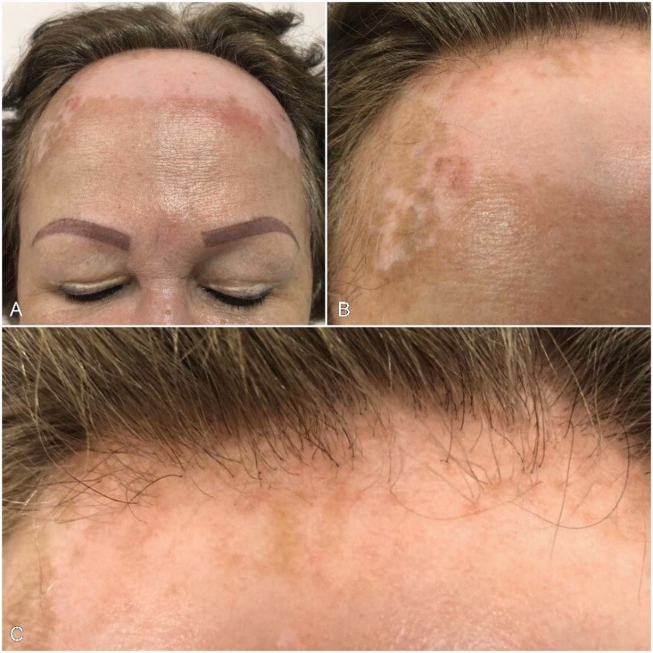 ¿Cómo afecta el vitíligo al cabello?