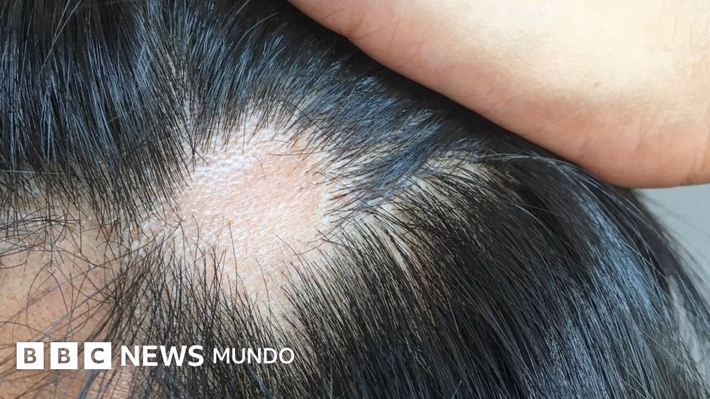 ¿Qué causa la enfermedad de Hashimoto?