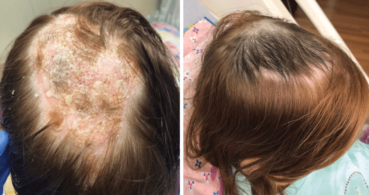 ¿Qué vitamina te falta cuando tienes psoriasis?