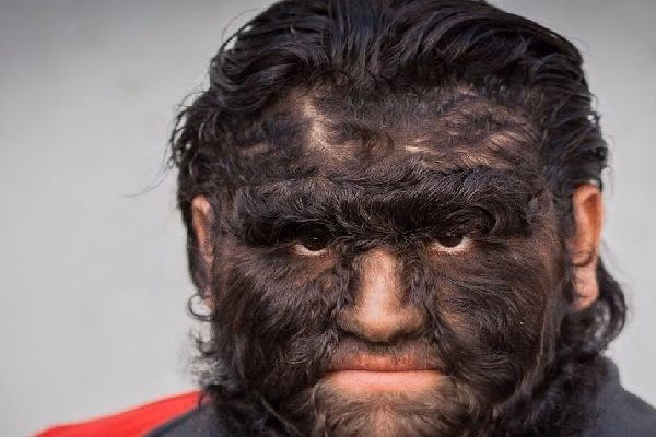 ¿Por qué da alopesia?