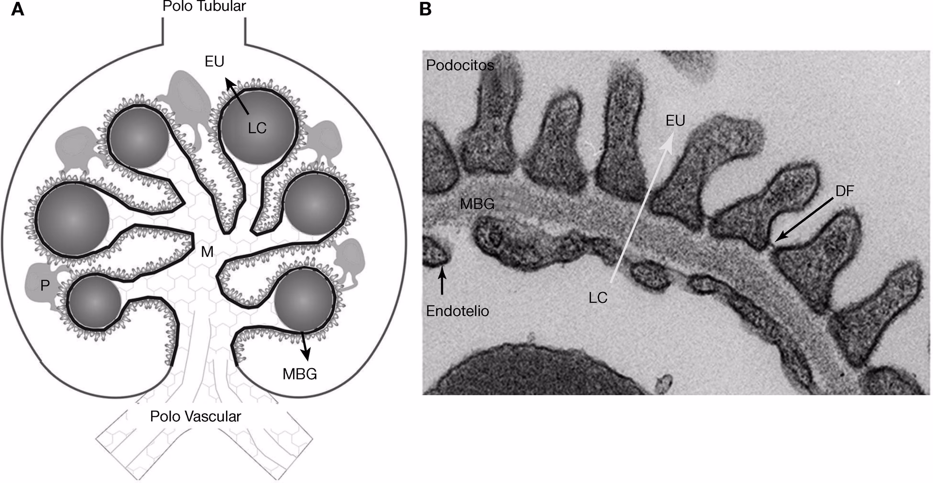 ¿Qué causa el engrosamiento de las paredes del riñón?