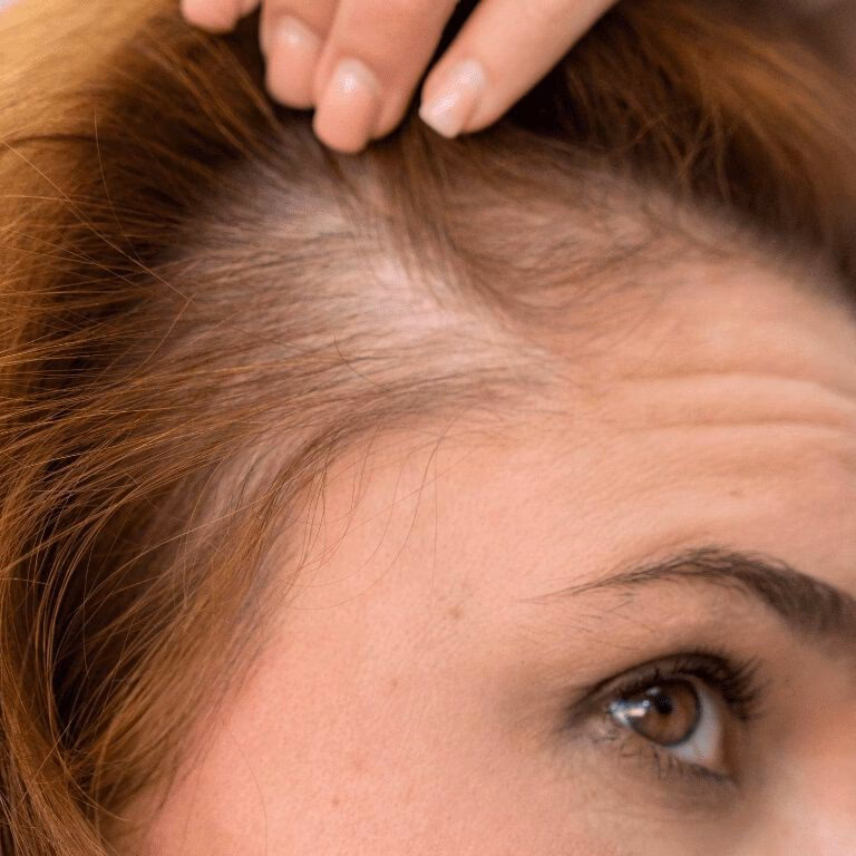 ¿Cuánto cabello es normal que se caiga en una mujer?