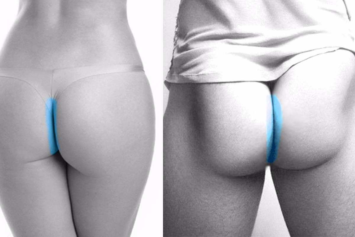 ¿Es normal tener vello en los glúteos?