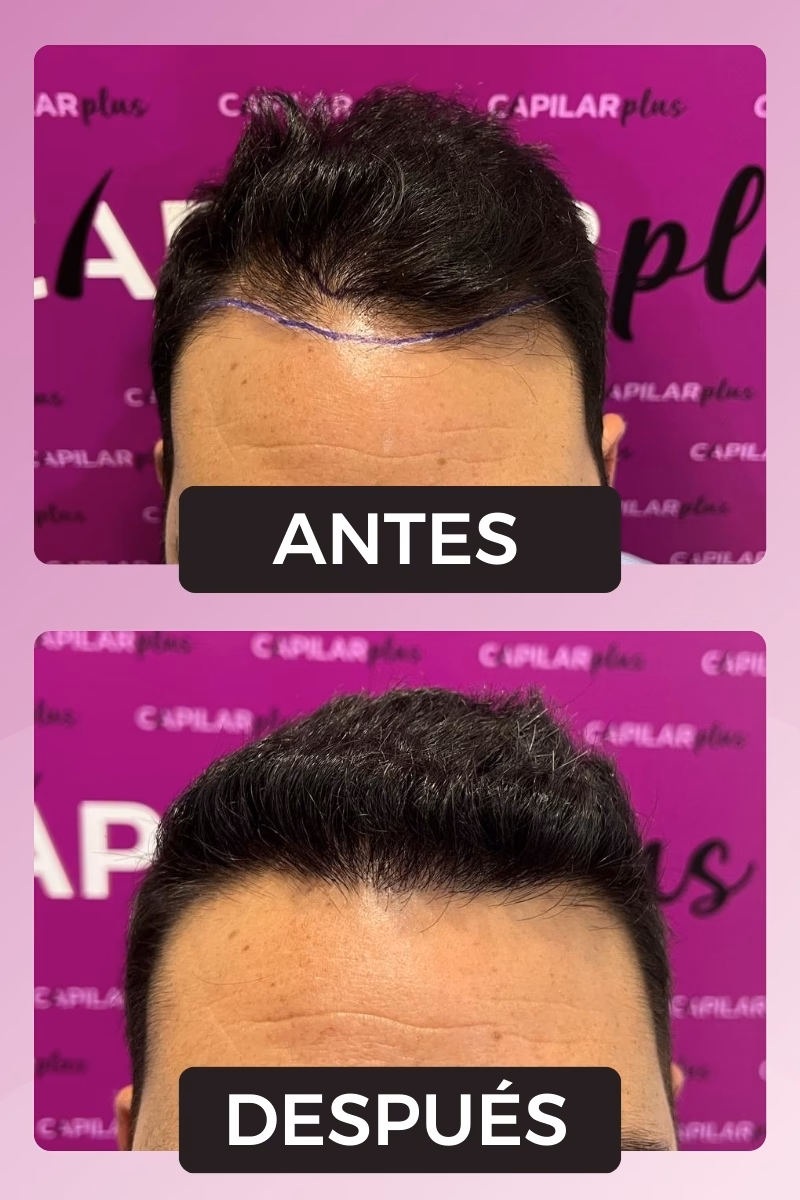 ¿Qué se estudia para el injerto capilar?