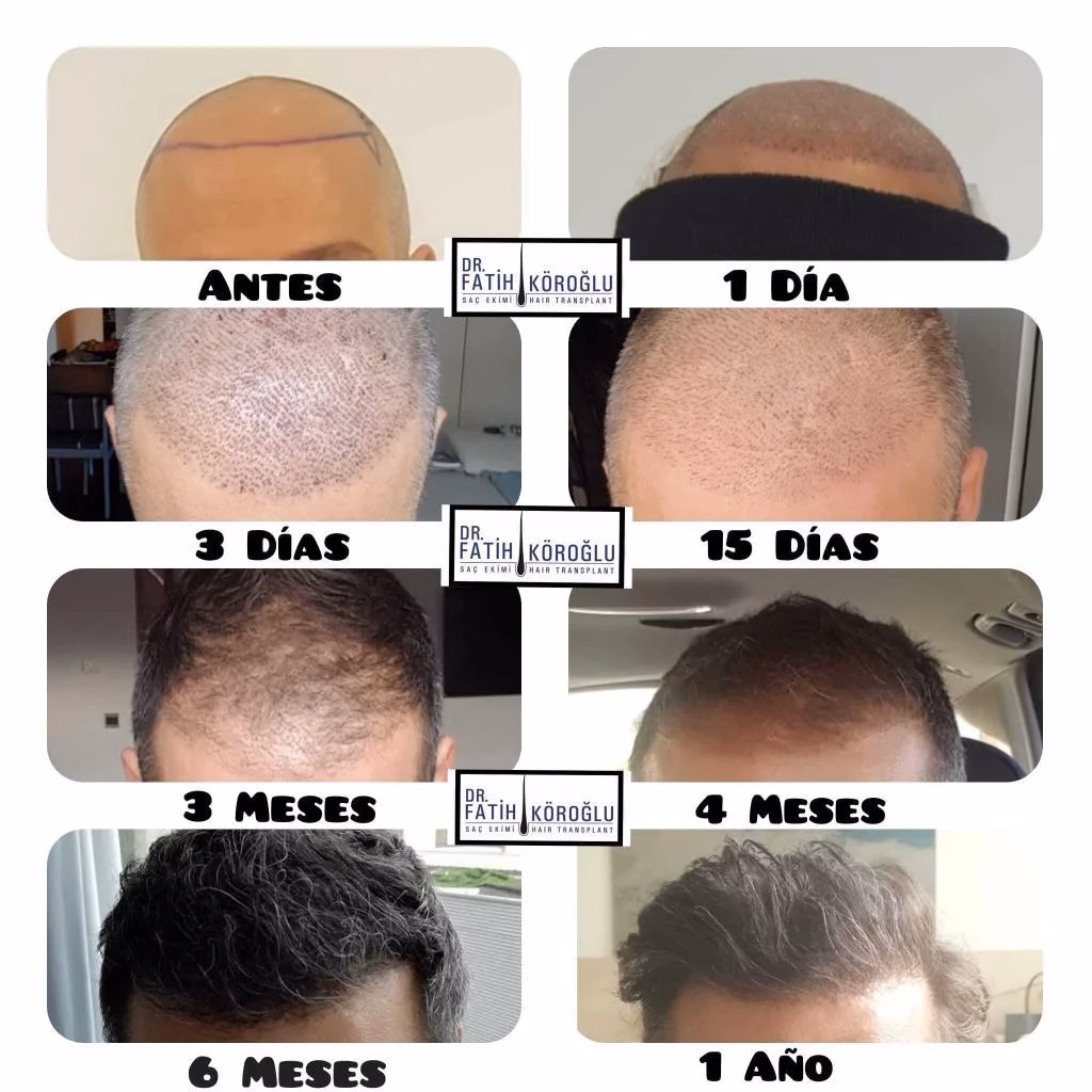 ¿Cuáles son las etapas del trasplante de cabello?