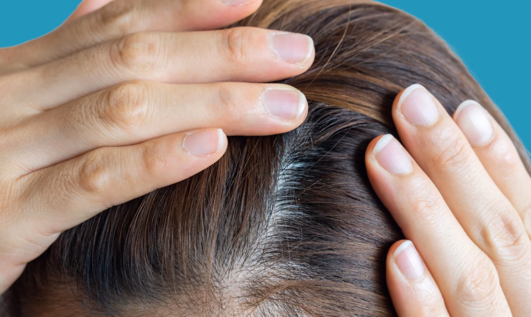 ¿Cómo saber si se me cae el pelo por falta de hierro?