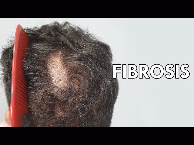 ¿Qué es la fibrosis en el cuero cabelludo?