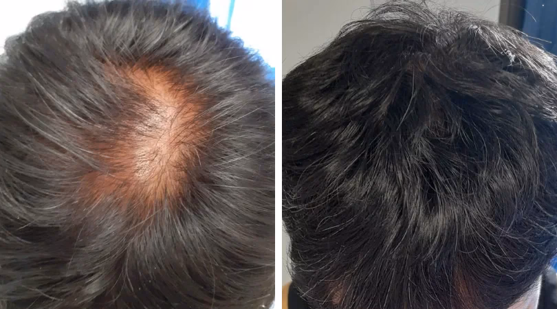 ¿Qué es la filtración de plasma?