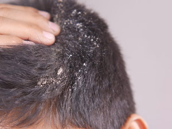 ¿Cuánto dura la foliculitis en la cabeza?