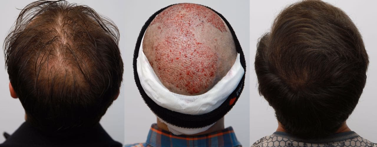 ¿Cuál es la tasa de éxito de los trasplantes de cabello de Turquía?