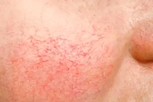 ¿Cuáles son las causas de la fragilidad capilar en los brazos?