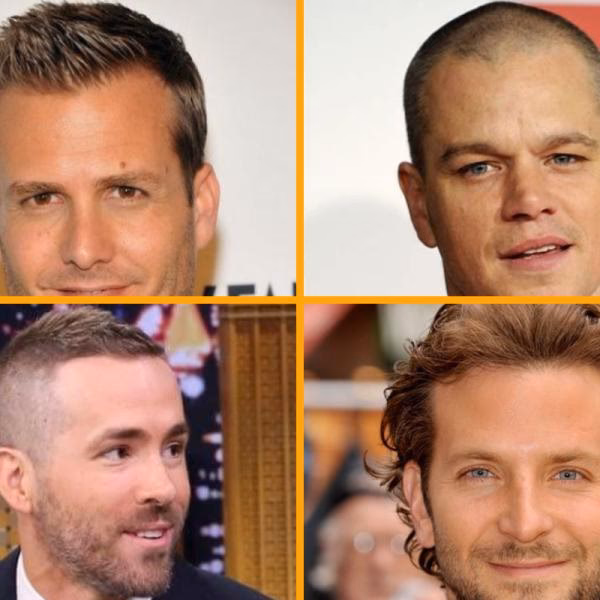 ¿Cómo arreglar una frente en forma de M?