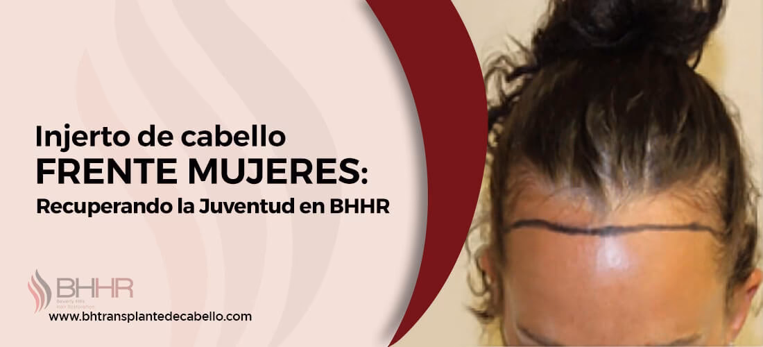 ¿Cuáles son los tipos de trasplante de cabello?