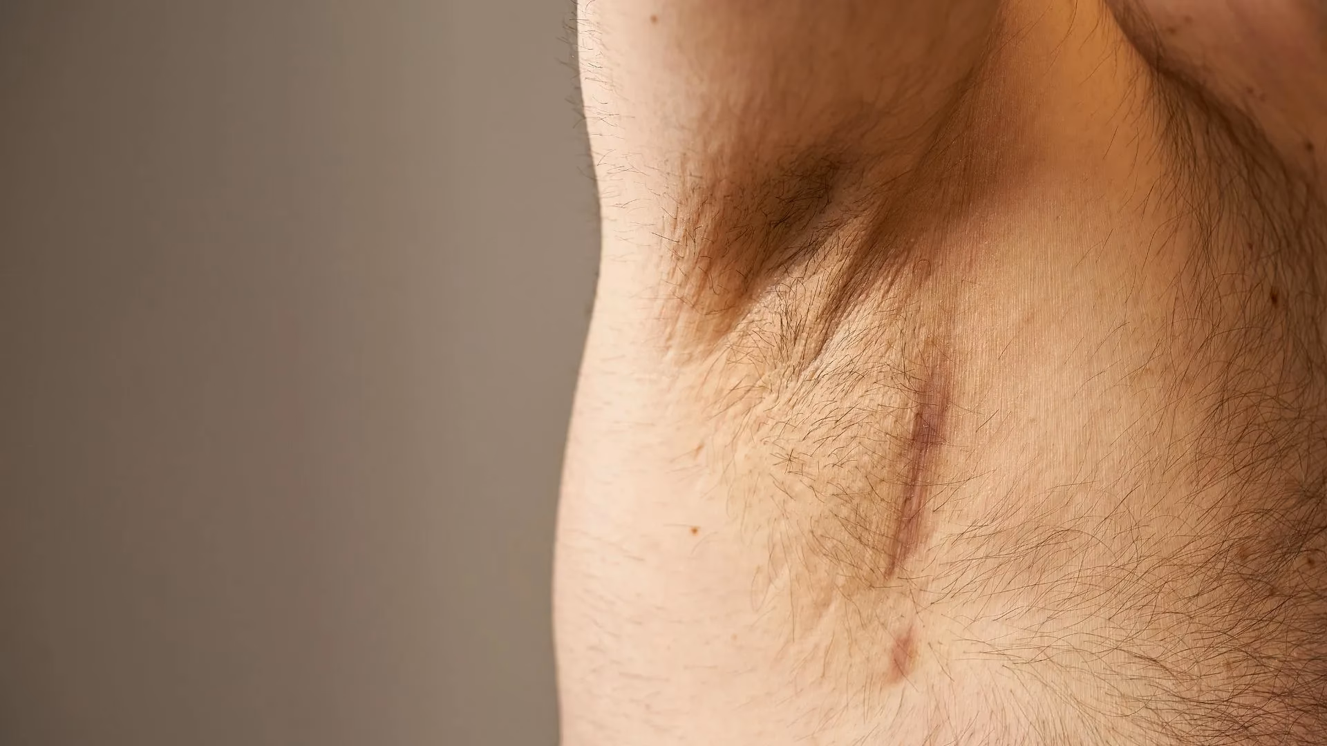 ¿Qué enfermedad autoinmune inflama los ganglios?