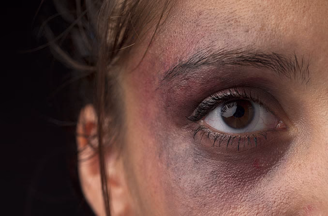 ¿Cuáles son las consecuencias de un balonazo en el ojo?