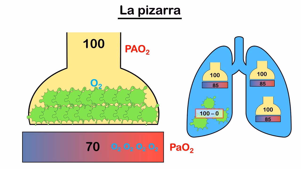 ¿Cómo se calcula el gradiente alveolo-arterial de oxígeno?