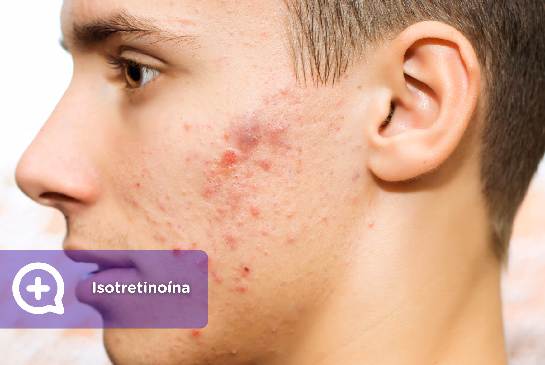 ¿Puede la isotretinoína tratar la dermatitis seborreica?