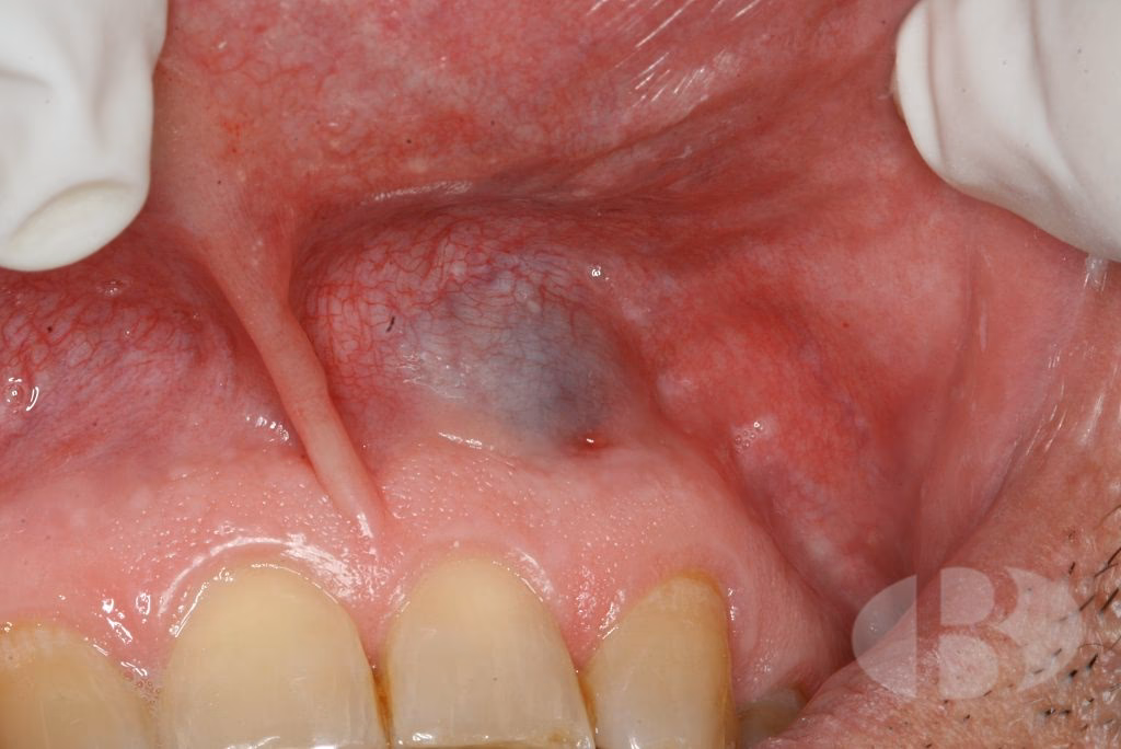 ¿Qué es un hemangioma gingival?