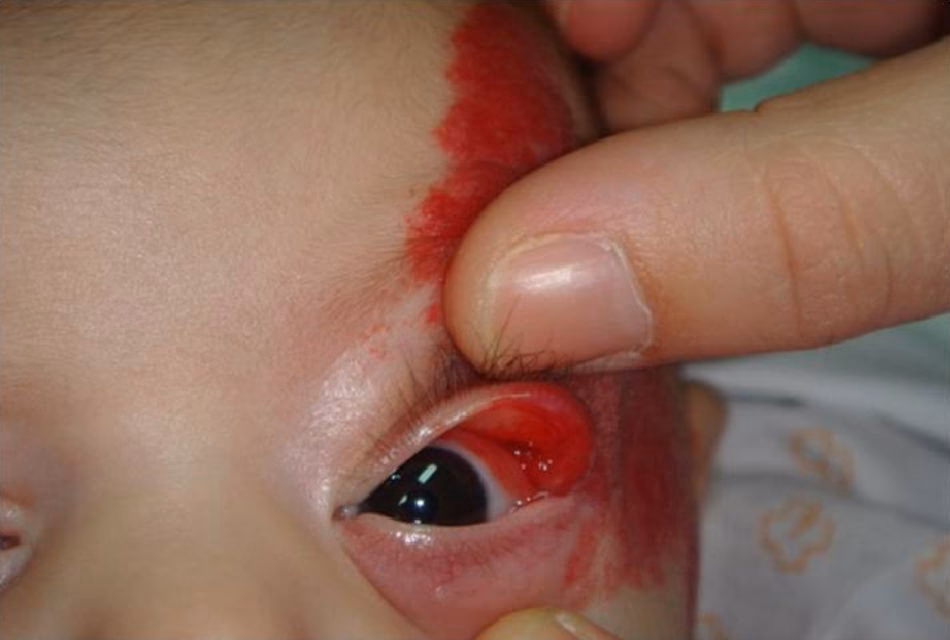 ¿Qué consecuencias trae el hemangioma?