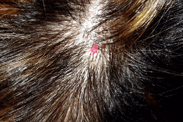 ¿Cuál es el tratamiento para un hemangioma capilar?