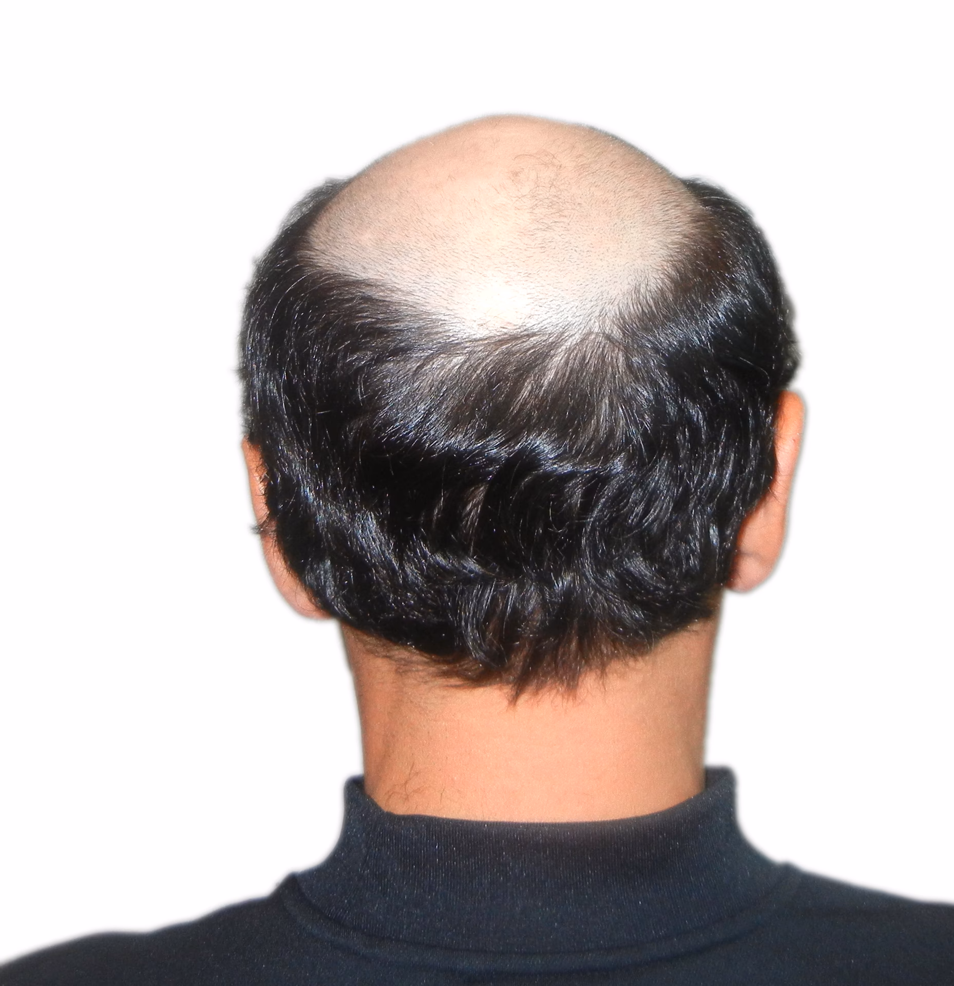 ¿Qué tan atractivo es un hombre calvo?