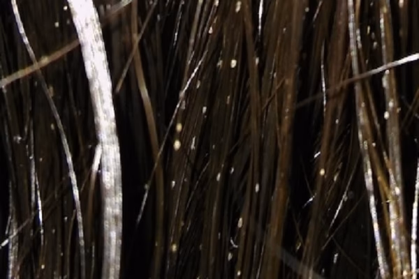 ¿Qué son las piedritas blancas en mi cuero cabelludo?