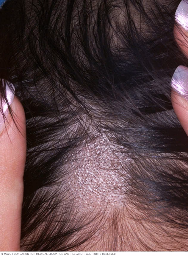 ¿Cómo saber si es un hongo o alopecia?