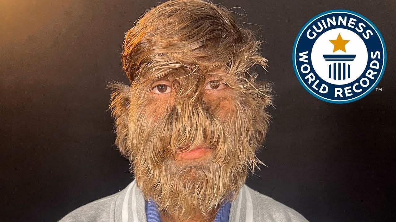 ¿Quién es el hombre con más pelo en el mundo?
