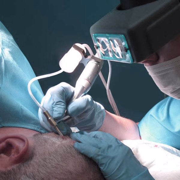 ¿Cuál es el último método de trasplante de cabello?