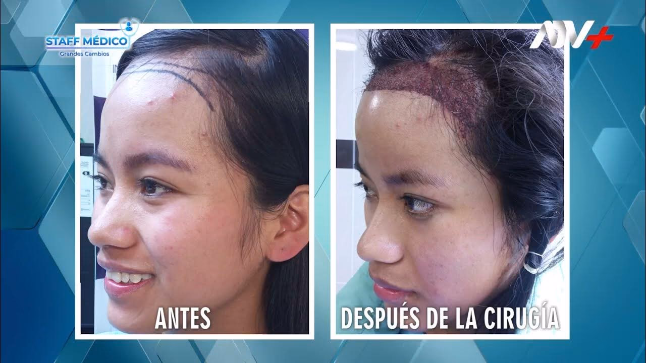 ¿Cuánto le cuesta a una mujer hacerse un trasplante de cabello?
