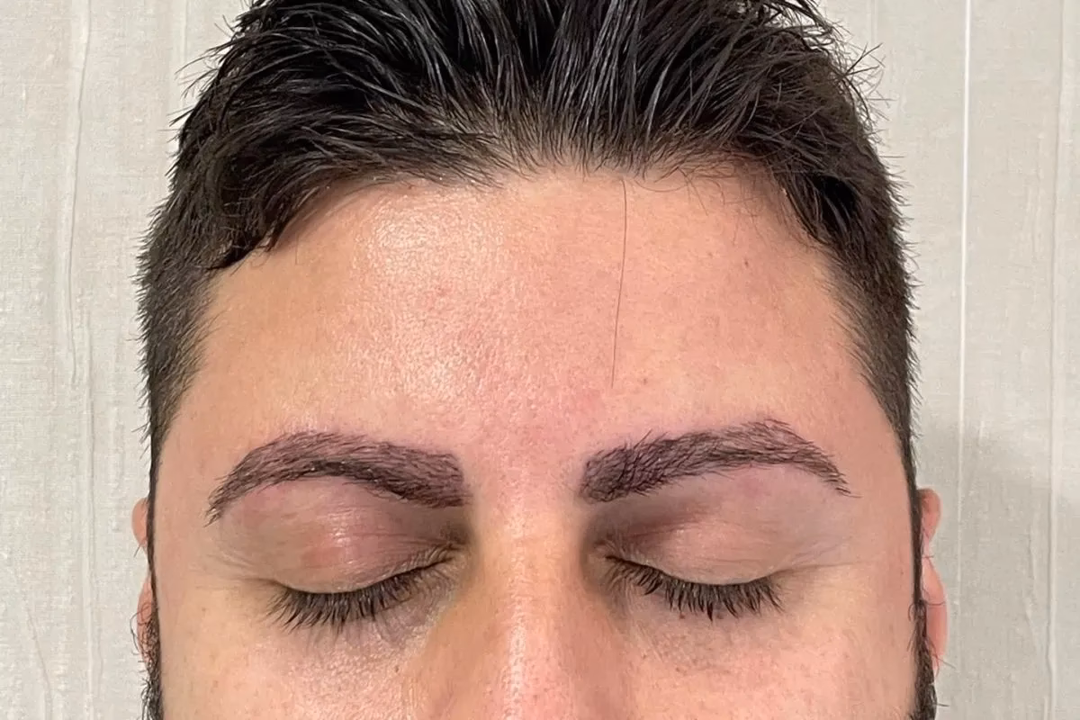 ¿Cuánto cuesta un implante de cejas?