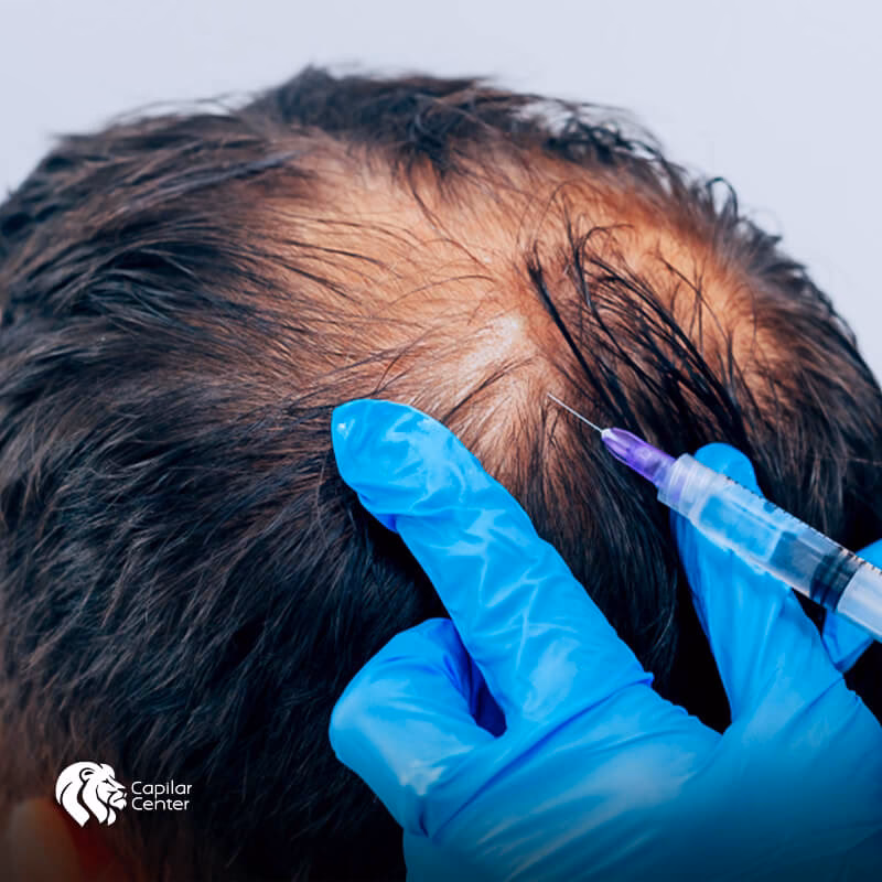 ¿Pueden las inyecciones de células madre hacer crecer el cabello?