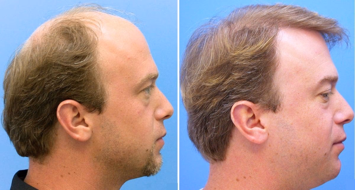 ¿Cuánto vale un injerto capilar en Barcelona?