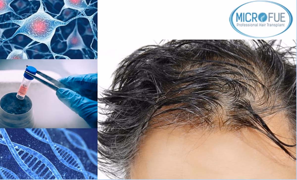 ¿Cuánto cuesta un trasplante de cabello con células madre?