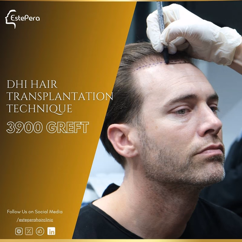 ¿5 g de creatina al día provoca caída del cabello?